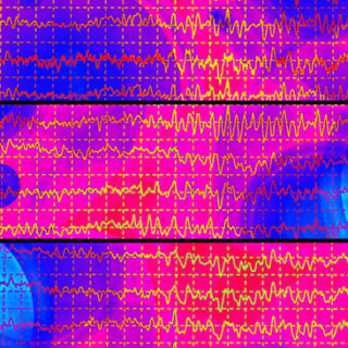 Hjärnvågor vid ett epilepsianfall i ett EEG