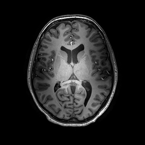 Röntgen av hjärna